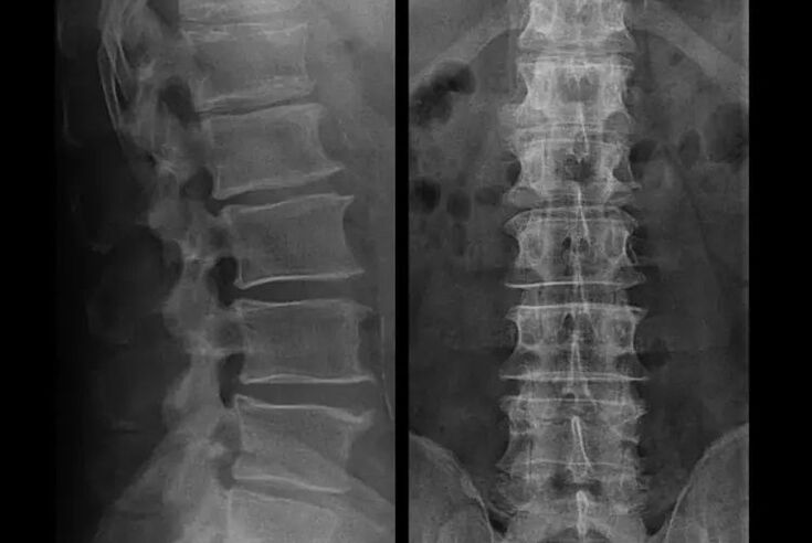 osteocondrosi alla radiografia