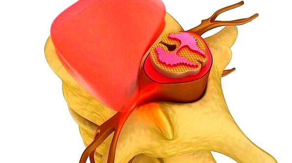 osteocondrosi della colonna vertebrale toracica l'essenza della malattia