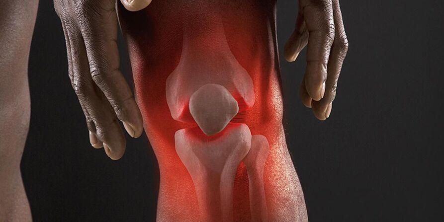 La sensazione di bruciore nella zona del ginocchio è un sintomo di gonartrosi